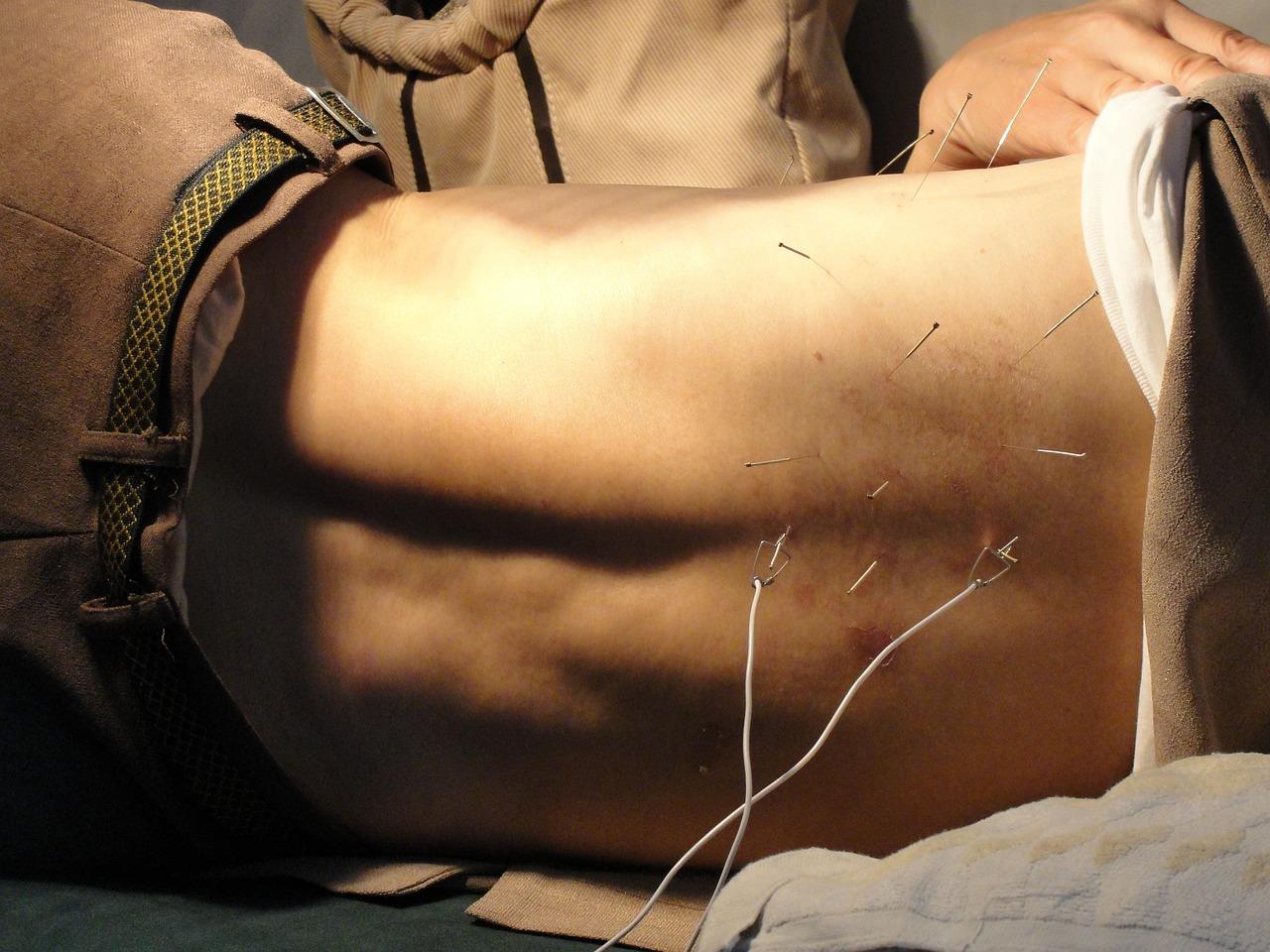 Een man wordt behandeld met acupunctuur in Purmerend